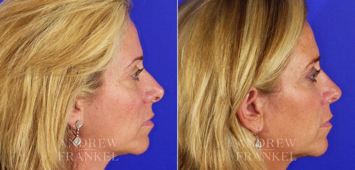 Revision Rhinoplasty before and after photos in Beverly Hills, CA, Patient 4611