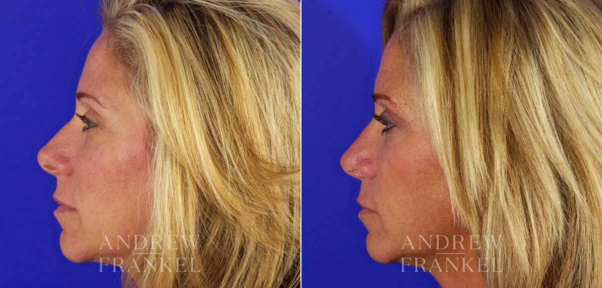 Revision Rhinoplasty before and after photos in Beverly Hills, CA, Patient 4611