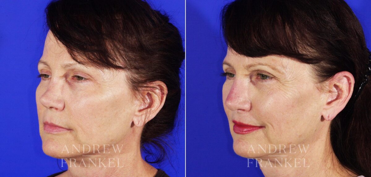 Revision Rhinoplasty before and after photos in Beverly Hills, CA, Patient 4625