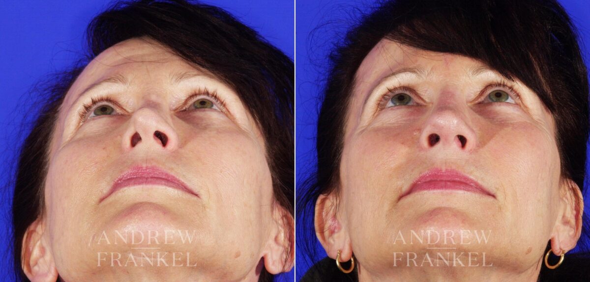 Revision Rhinoplasty before and after photos in Beverly Hills, CA, Patient 4625
