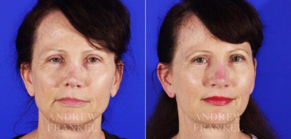 Revision Rhinoplasty before and after photos in Beverly Hills, CA, Patient 4625