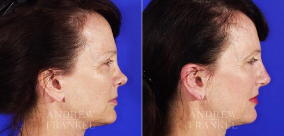 Revision Rhinoplasty before and after photos in Beverly Hills, CA, Patient 4625