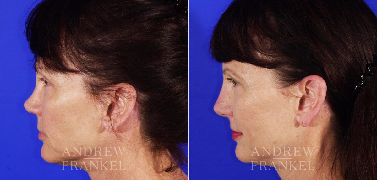 Revision Rhinoplasty before and after photos in Beverly Hills, CA, Patient 4625