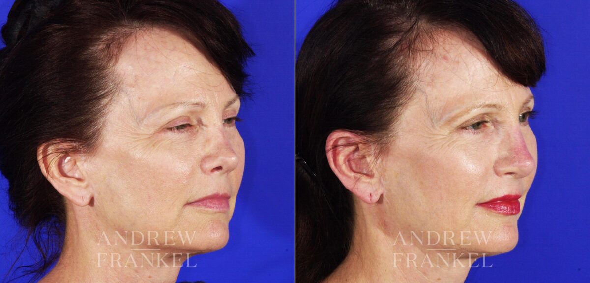 Revision Rhinoplasty before and after photos in Beverly Hills, CA, Patient 4625