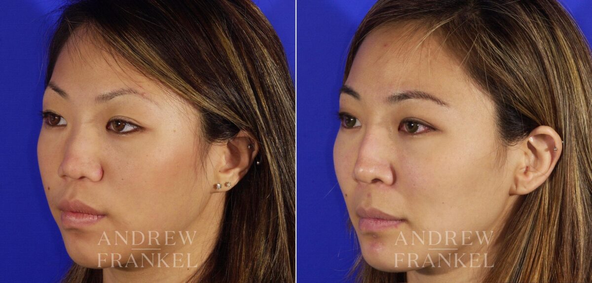 Revision Rhinoplasty before and after photos in Beverly Hills, CA, Patient 4652