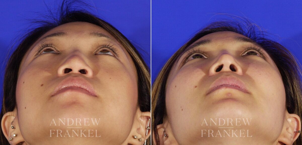 Revision Rhinoplasty before and after photos in Beverly Hills, CA, Patient 4652