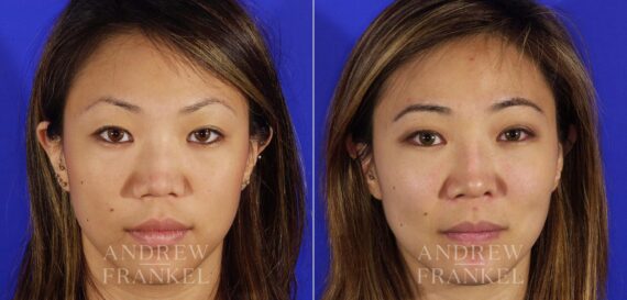 Revision Rhinoplasty before and after photos in Beverly Hills, CA, Patient 4652