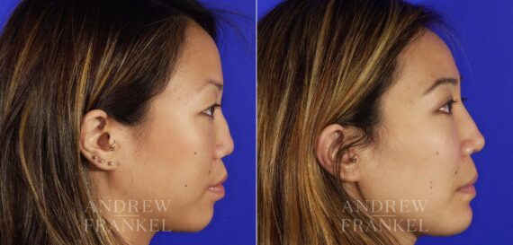 Revision Rhinoplasty before and after photos in Beverly Hills, CA, Patient 4652
