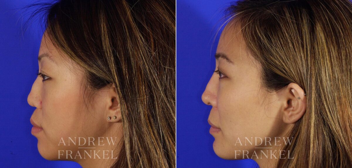 Revision Rhinoplasty before and after photos in Beverly Hills, CA, Patient 4652