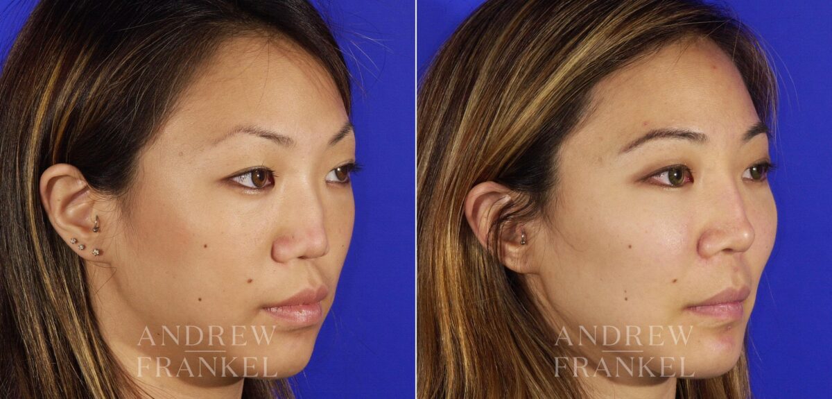 Revision Rhinoplasty before and after photos in Beverly Hills, CA, Patient 4652