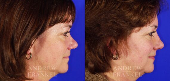 Revision Rhinoplasty before and after photos in Beverly Hills, CA, Patient 4711