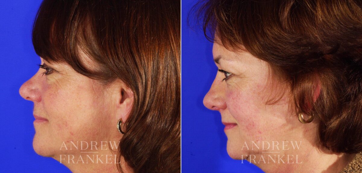 Revision Rhinoplasty before and after photos in Beverly Hills, CA, Patient 4711