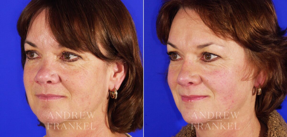 Revision Rhinoplasty before and after photos in Beverly Hills, CA, Patient 4711