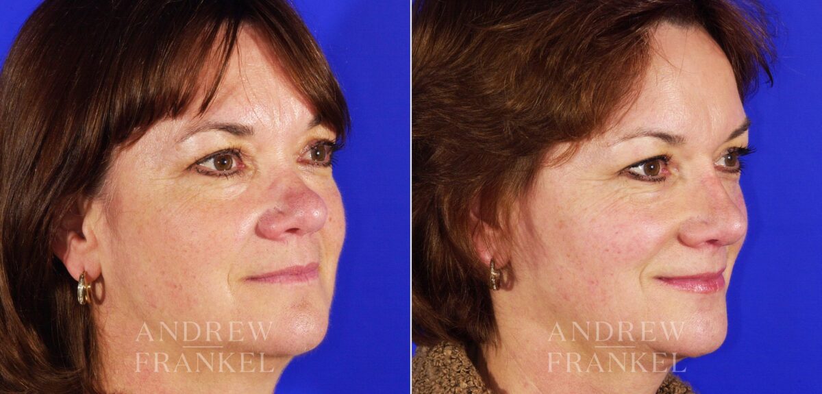 Revision Rhinoplasty before and after photos in Beverly Hills, CA, Patient 4711