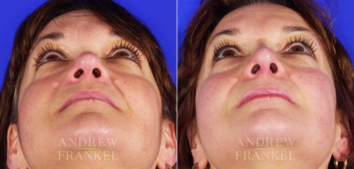 Revision Rhinoplasty before and after photos in Beverly Hills, CA, Patient 4711