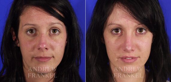 Revision Rhinoplasty before and after photos in Beverly Hills, CA, Patient 4772