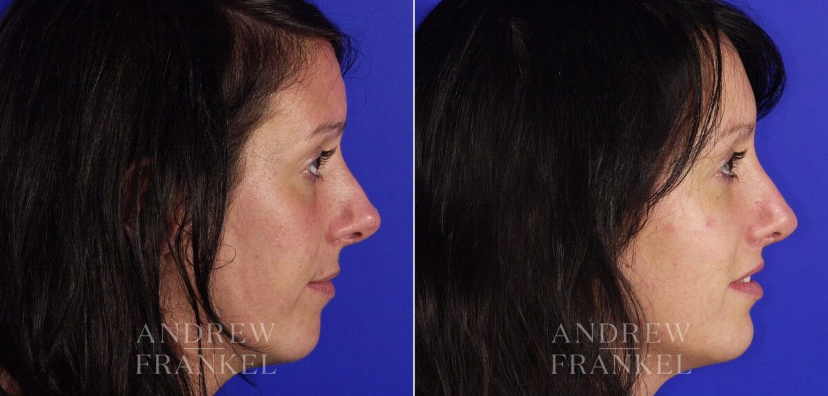 Revision Rhinoplasty before and after photos in Beverly Hills, CA, Patient 4772