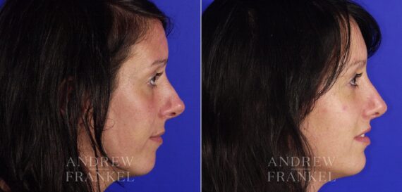 Revision Rhinoplasty before and after photos in Beverly Hills, CA, Patient 4772