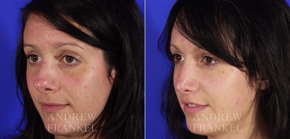 Revision Rhinoplasty before and after photos in Beverly Hills, CA, Patient 4772