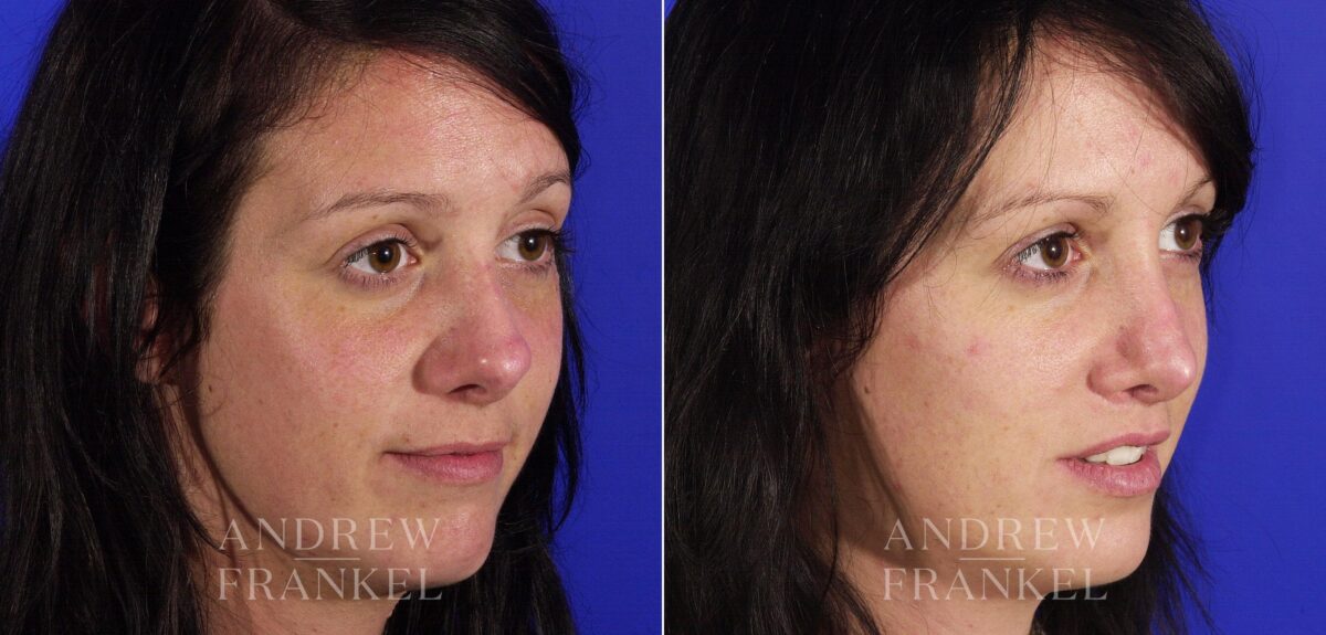 Revision Rhinoplasty before and after photos in Beverly Hills, CA, Patient 4772