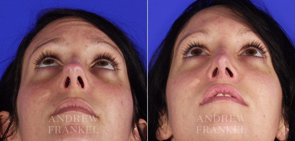 Revision Rhinoplasty before and after photos in Beverly Hills, CA, Patient 4772