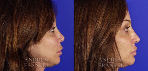 Revision Rhinoplasty before and after photos in Beverly Hills, CA, Patient 4789