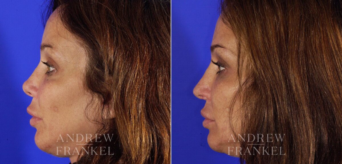 Revision Rhinoplasty before and after photos in Beverly Hills, CA, Patient 4789