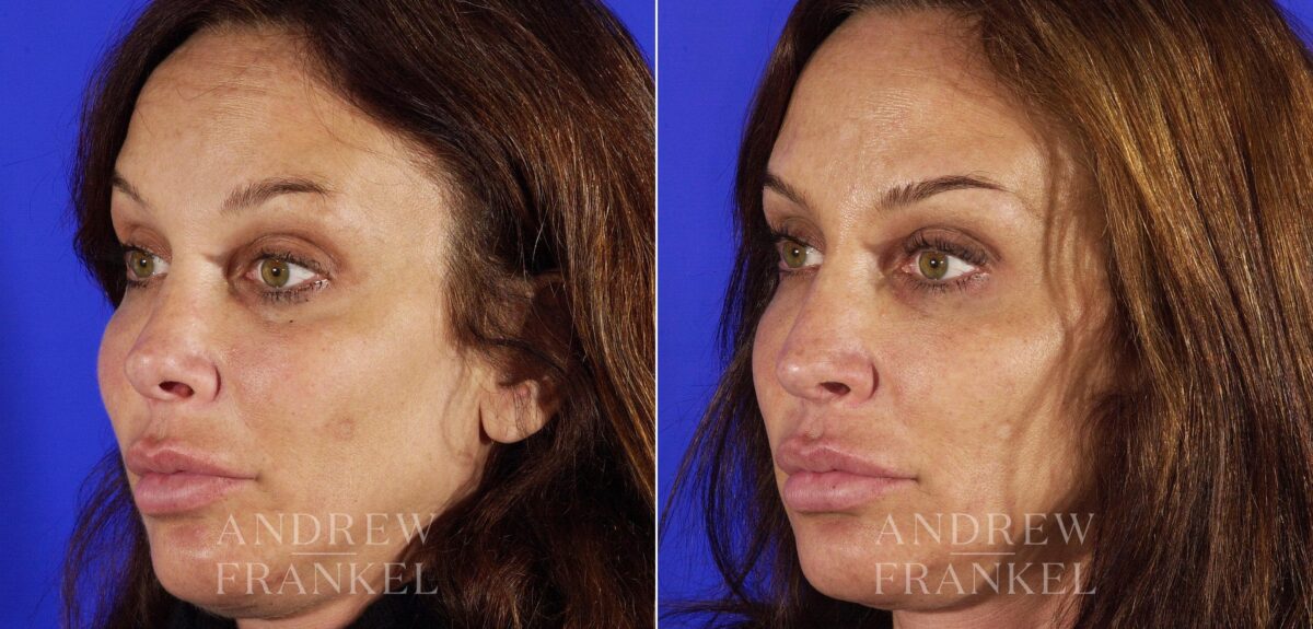 Revision Rhinoplasty before and after photos in Beverly Hills, CA, Patient 4789