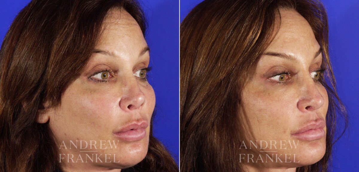 Revision Rhinoplasty before and after photos in Beverly Hills, CA, Patient 4789