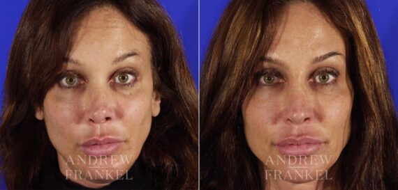 Revision Rhinoplasty before and after photos in Beverly Hills, CA, Patient 4789