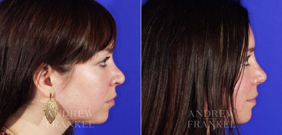 Revision Rhinoplasty before and after photos in Beverly Hills, CA, Patient 4846