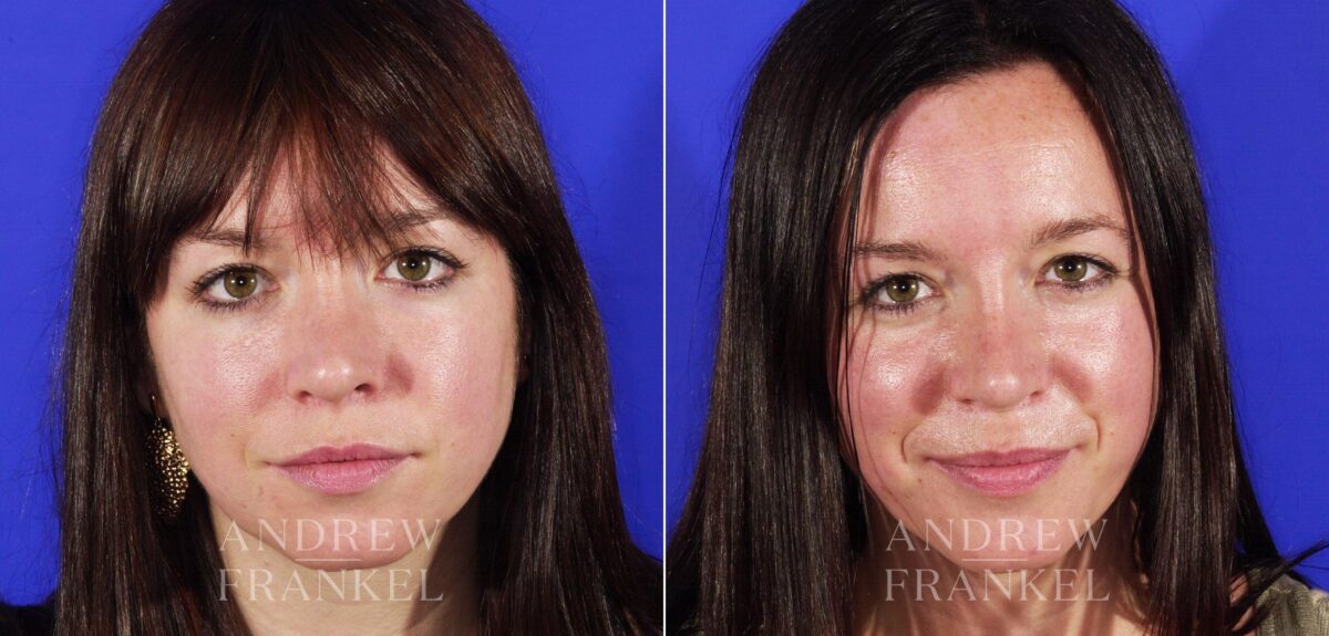 Revision Rhinoplasty before and after photos in Beverly Hills, CA, Patient 4846
