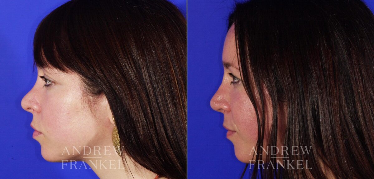 Revision Rhinoplasty before and after photos in Beverly Hills, CA, Patient 4846