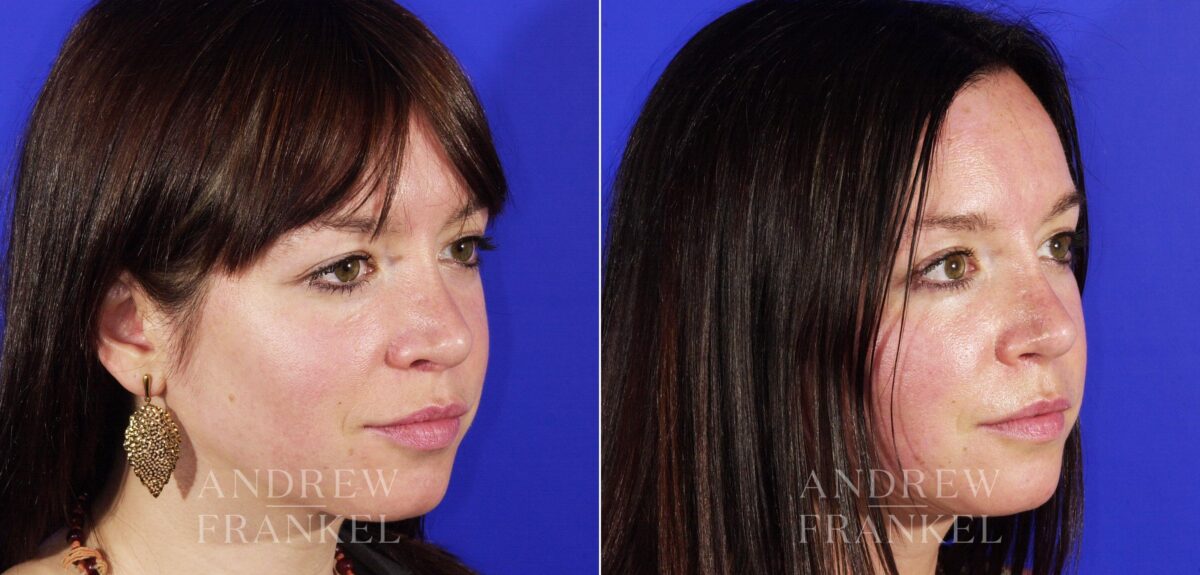 Revision Rhinoplasty before and after photos in Beverly Hills, CA, Patient 4846