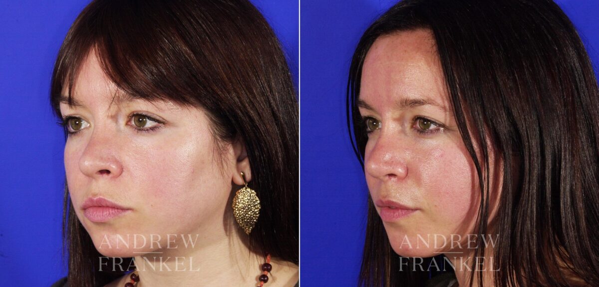 Revision Rhinoplasty before and after photos in Beverly Hills, CA, Patient 4846