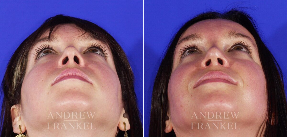 Revision Rhinoplasty before and after photos in Beverly Hills, CA, Patient 4846