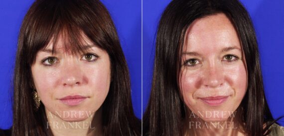 Revision Rhinoplasty before and after photos in Beverly Hills, CA, Patient 4846