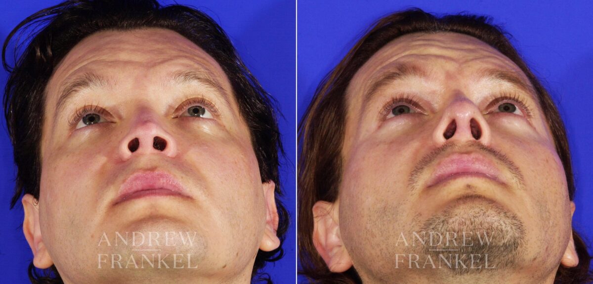 Revision Rhinoplasty before and after photos in Beverly Hills, CA, Patient 4917