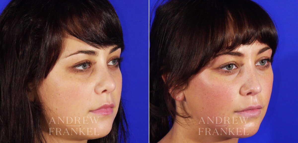 Revision Rhinoplasty before and after photos in Beverly Hills, CA, Patient 4930