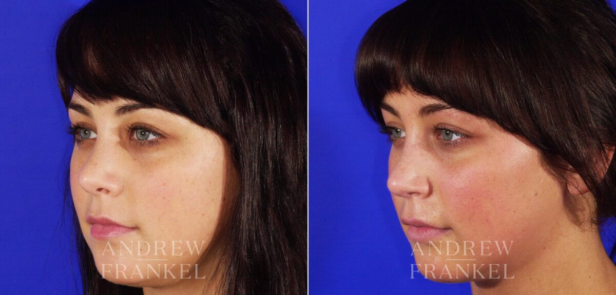 Revision Rhinoplasty before and after photos in Beverly Hills, CA, Patient 4930