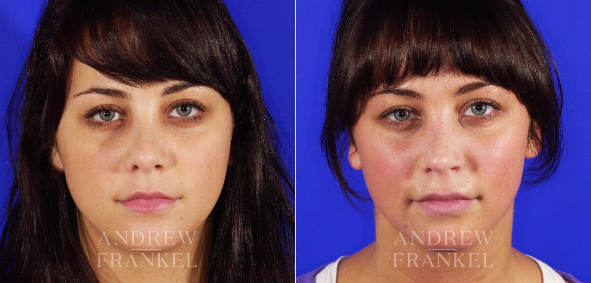 Revision Rhinoplasty before and after photos in Beverly Hills, CA, Patient 4930
