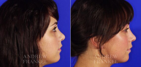 Revision Rhinoplasty before and after photos in Beverly Hills, CA, Patient 4930