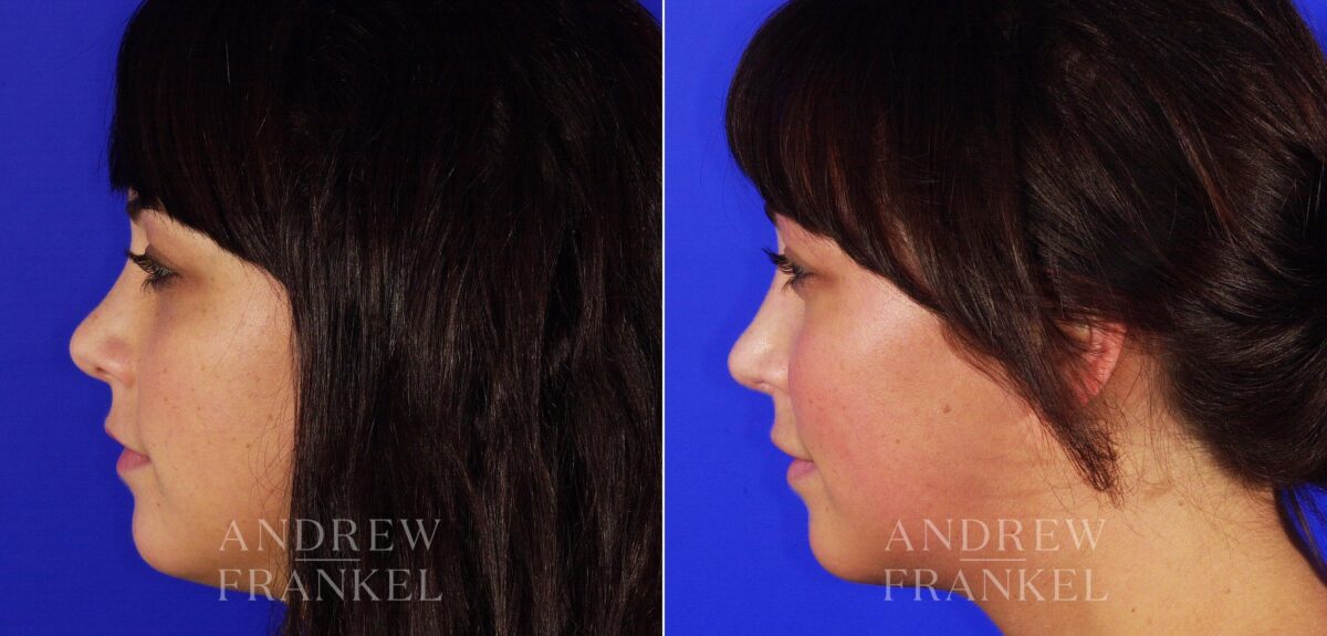 Revision Rhinoplasty before and after photos in Beverly Hills, CA, Patient 4930