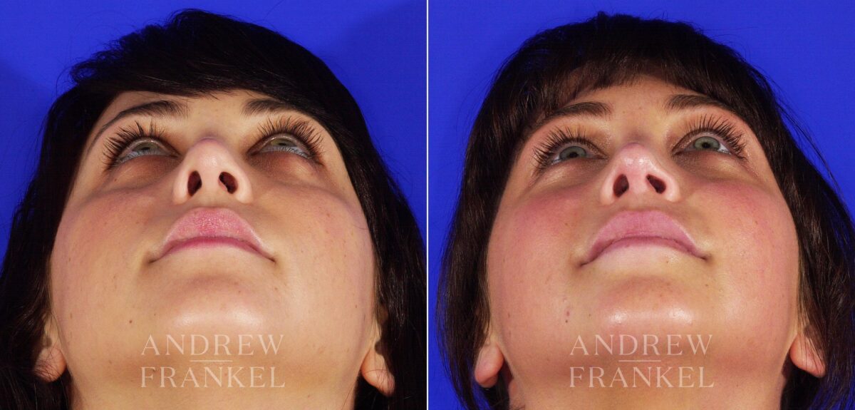 Revision Rhinoplasty before and after photos in Beverly Hills, CA, Patient 4930