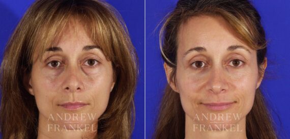 Revision Rhinoplasty before and after photos in Beverly Hills, CA, Patient 5797