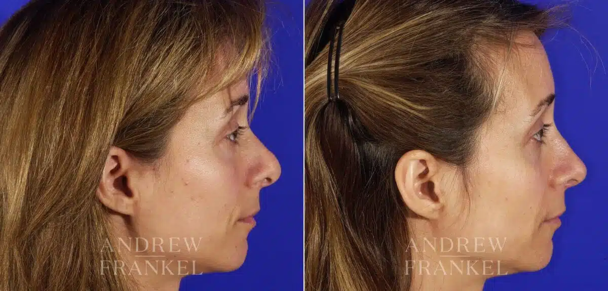 Revision Rhinoplasty before and after photos in Beverly Hills, CA, Patient 5797