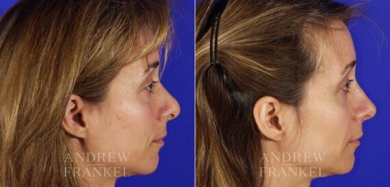 Revision Rhinoplasty before and after photos in Beverly Hills, CA, Patient 5797