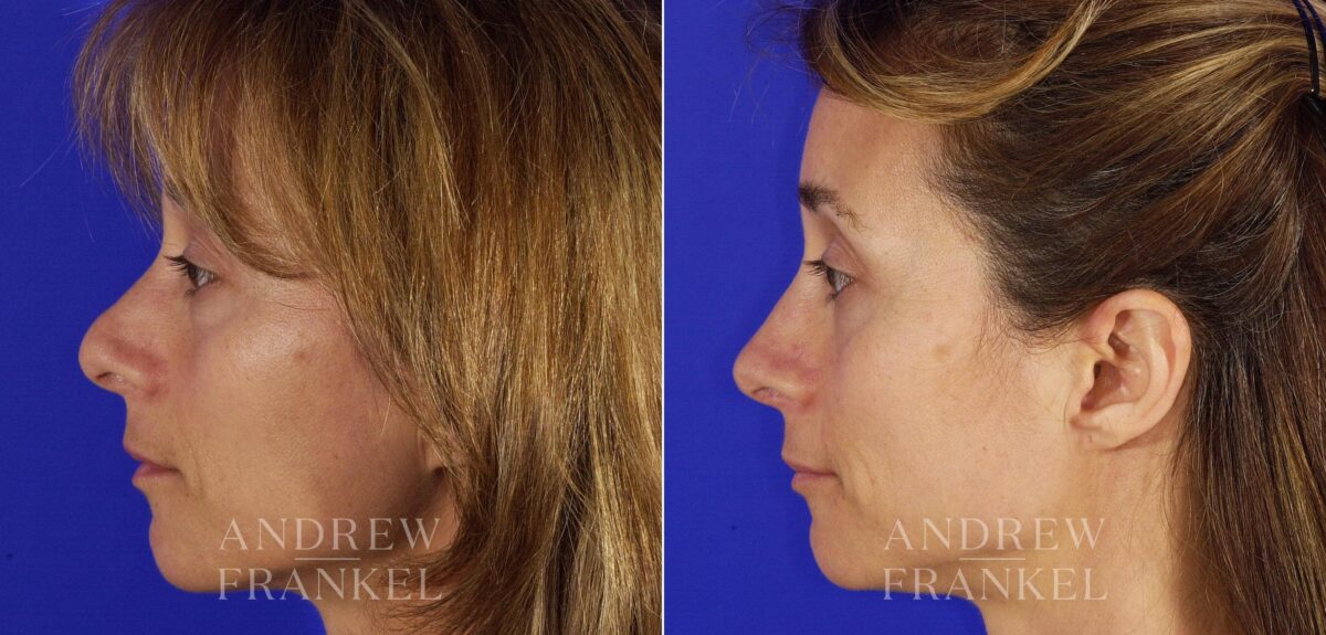 Revision Rhinoplasty before and after photos in Beverly Hills, CA, Patient 5797