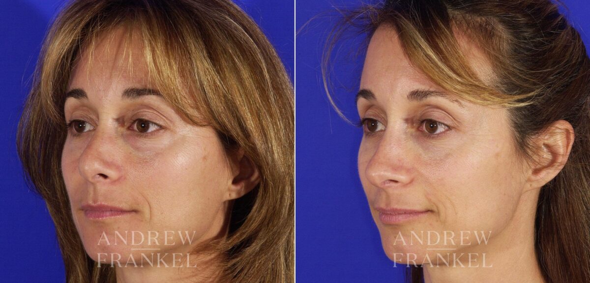 Revision Rhinoplasty before and after photos in Beverly Hills, CA, Patient 5797