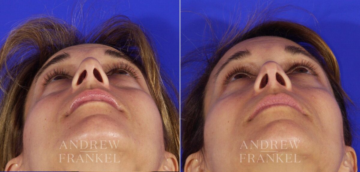 Revision Rhinoplasty before and after photos in Beverly Hills, CA, Patient 5797